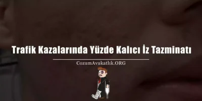 Trafik Kazalarında Yüzde Sabit İz Tazminatı